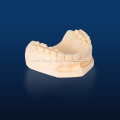 High strength IPS Emax Onlay and Inlay